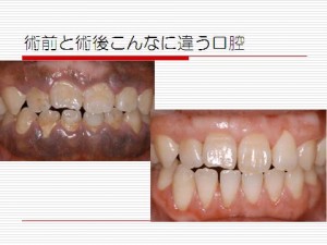 術前と術後の口内比較