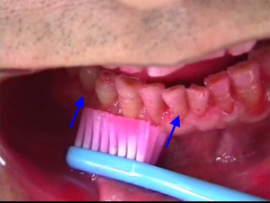 チャーターズ法による歯磨き