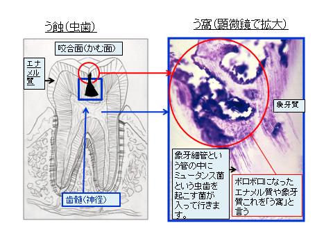 虫歯になった歯の様子