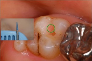 細菌に感染した部分がある歯