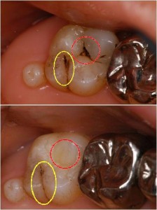う蝕治療前後の歯