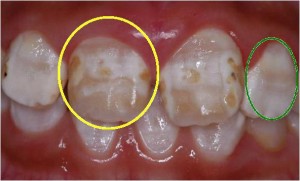 平滑面う蝕になっている歯