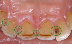 接触面う蝕になっている歯