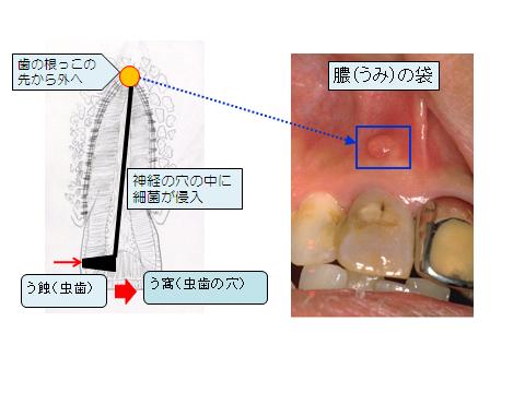 う蝕の進行の様子