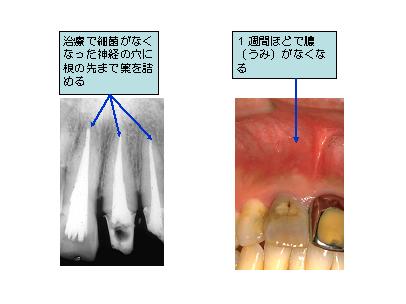 根管充填の様子