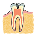 象牙質まで進行したう蝕