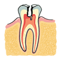 歯髄腔まで進行したう蝕