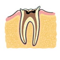 虫歯が進行して根っこだけになってしまった歯