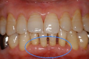 治療を受けて歯周炎が改善した歯茎
