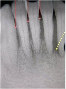 歯周炎患者のレントゲン写真
