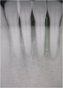 歯石除去後の歯周炎患者のレントゲン写真