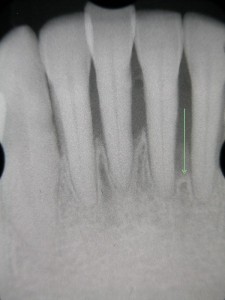 歯周炎の治療から半年後のレントゲン写真
