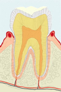 歯肉炎を起こした歯茎