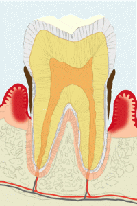 歯周炎になった歯茎