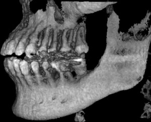 歯周病で顎の骨が破壊された人のレントゲン写真