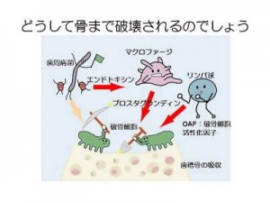 破骨細胞によって歯槽骨の吸収が進む様子