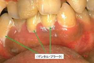 歯垢が溜まった口内