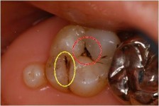 う蝕の歯の様子