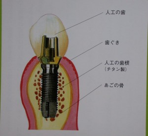 インプラントの構造