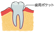 軽度歯周炎